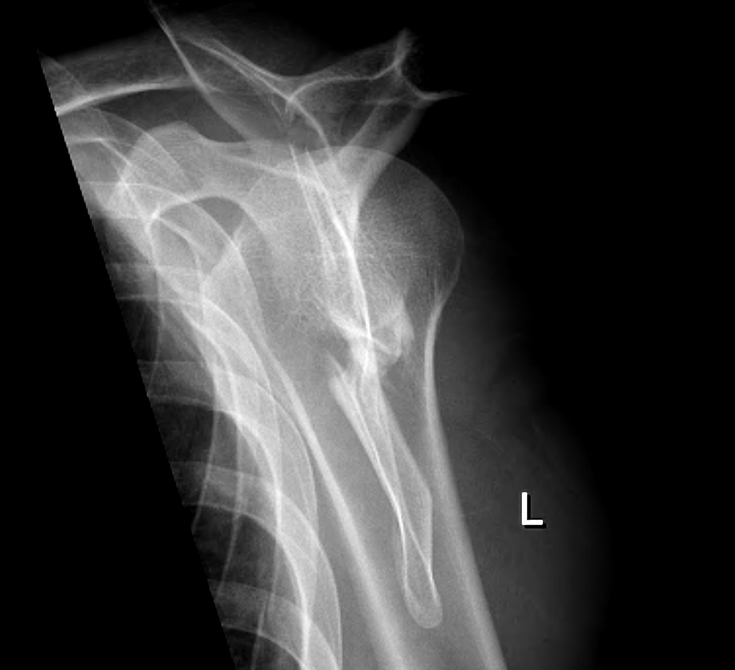 Scapula Body Fracture